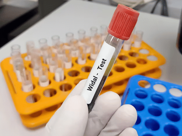 Widal Test