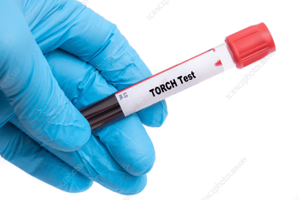 Torch IgG Test