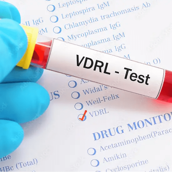 VDRL Test