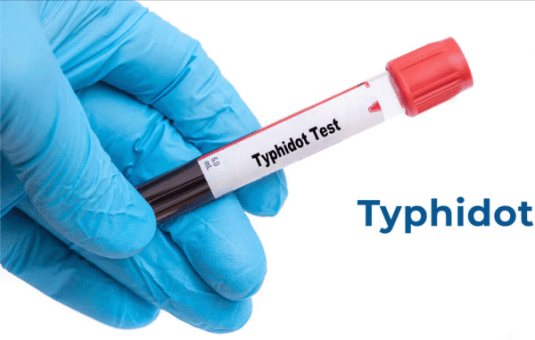 Typhidot igG Test